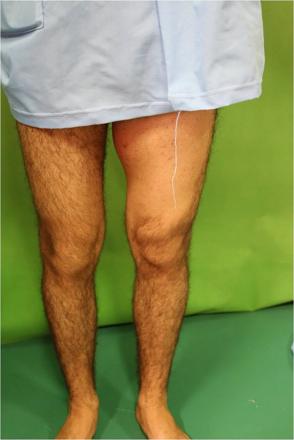 A huge soft tissue mass at medial compartment of left thigh