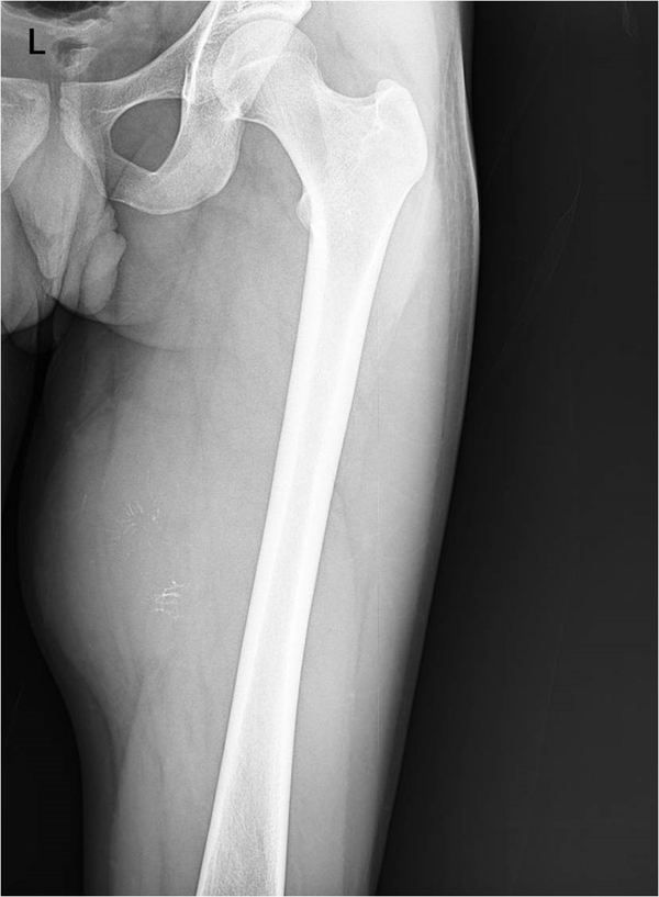 A huge soft tissue mass at medial compartment of left thigh with central calcification