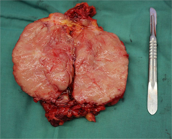 Macroscopic appearance of the mass after surgical excision