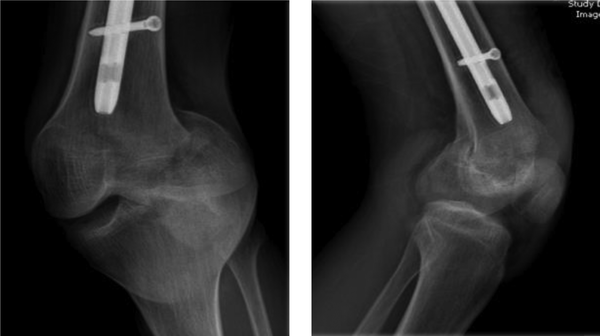 Anteroposterior and lateral radiography of the left knee that shows patellar dislocation and distal femur fracture