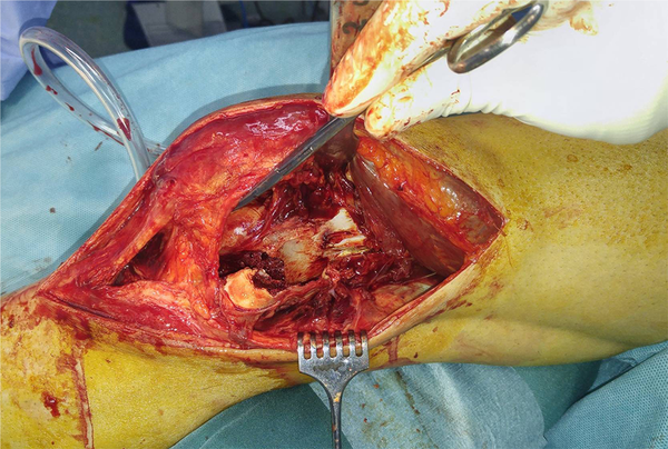 Intraoperative photography from the left knee that shows patella incarcerated into a Hoffa fracture