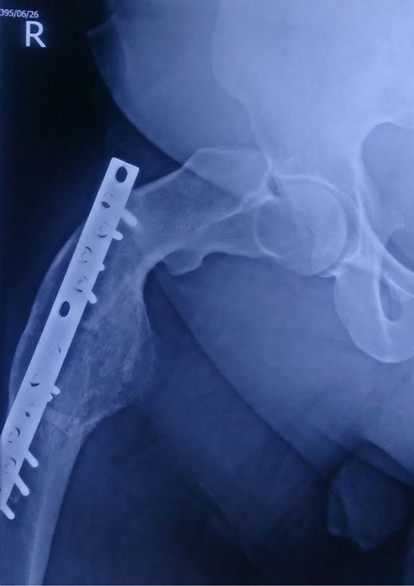 Lateral view of the right hip. Severe deformity in sub-trochanteric area is observed.