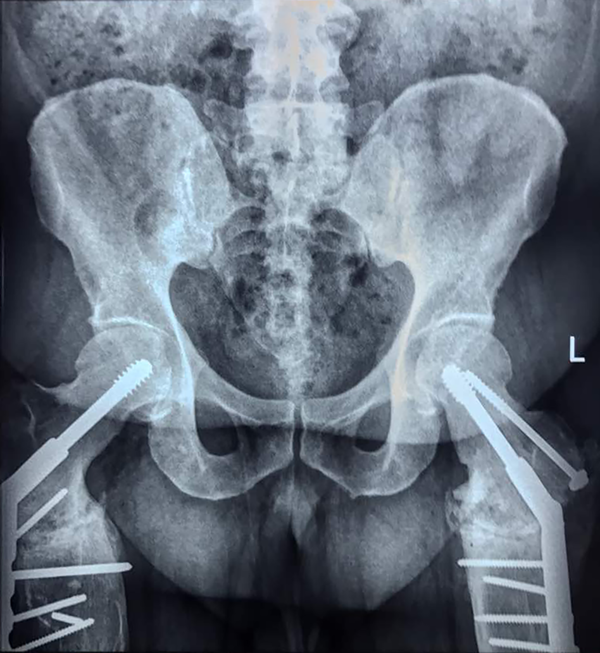 The pelvic radiography six months after surgical treatment showed suitable :union: with correction of neck-shaft angle.