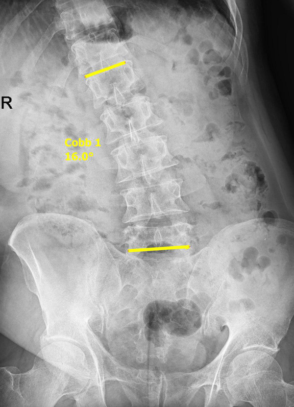 Lumbosacral radiography, AP view. Cobb';s angle between superior endplate of L1 and inferior endplate of L5 recorded as lumbosacral list.