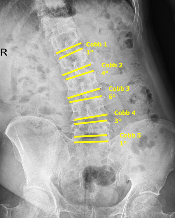 Lumbosacral radiography, AP view. Cobb';s angle measurement in each disc space showing the take-off occurred in L3 - L4 (6°).