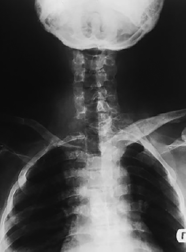 Anteroposterior radiograph of the spine showing the bone destruction in the C7-T1 region