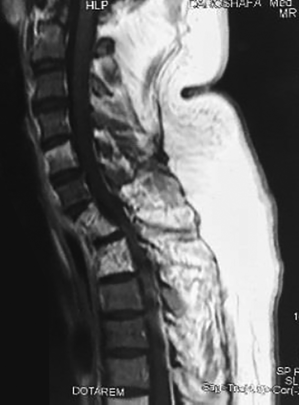 T2-weighted MRI showing a mixed pattern of hyper and hypo-intense signal identified at C7-T1 region and minimal pressure on the spinal cord