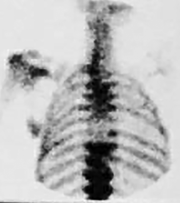 Bone scan of the spine showing an increased uptake in the lower cervical vertebrae and the upper thoracic vertebrae