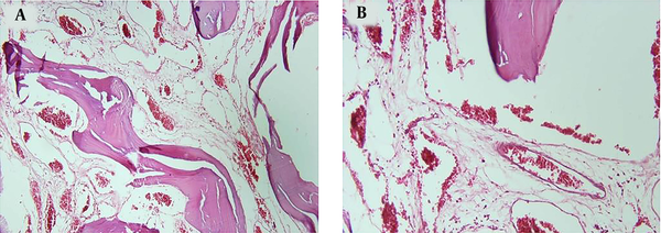 Histologic slides showing the expansion of marrow spaces filled by numerous small and large vascular channels with flat end and the endothelial linings (A) ×10; (B) ×20