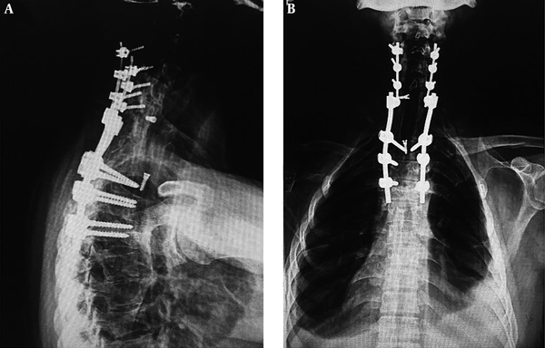 (A) lateral and (B) anteroposterior radiograph of the patient seven years after the final surgery showing fixation of lateral screws at C4, C5, C6 and bilateral pedicular screws at T2, T3, T4 vertebra. The fibular autograft which is fixed with two screws in corpectomy site (C7, T1) is also visible.